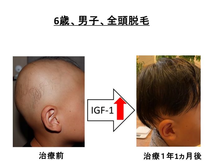 円形脱毛症　病院